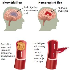 hipertenzija i moždani udar masažu