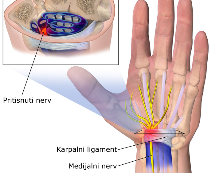 trošak operacije i liječenja artroze bol u zglobovima ruku tijekom dojenja