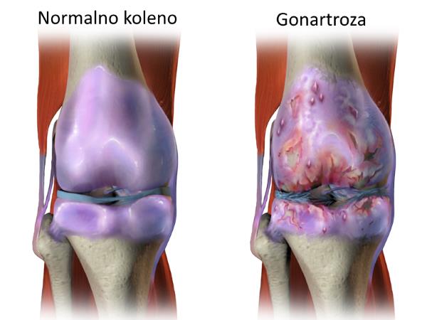 gonartroza artroza na koleno