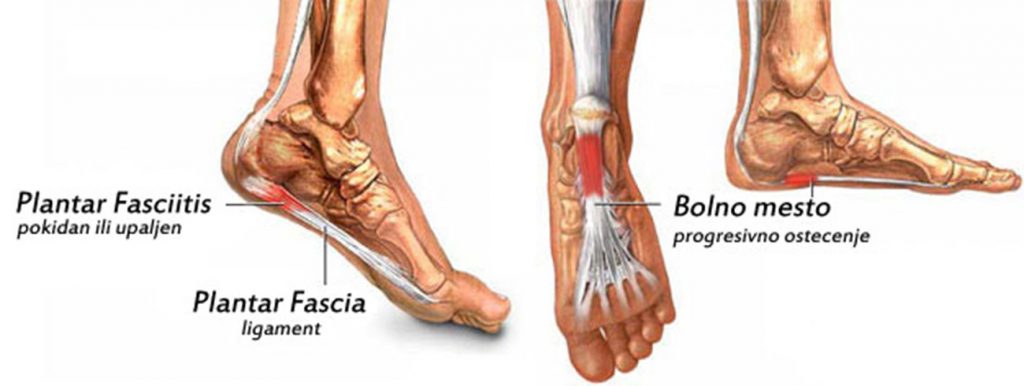 akutna bol u zglobovima stopala