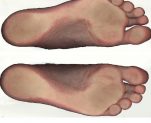 Najčešći urođeni deformitet stopala u dece – Talipes equinovarus congenitus