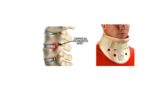 Cervikalna (vratna) diskus hernija