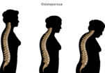 Osteoporoza i značaj nošenja midera